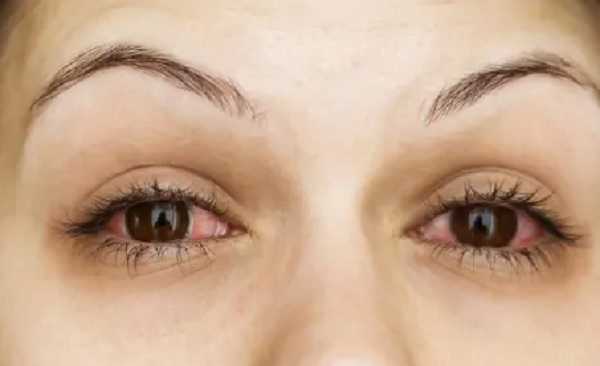 आंख में किसी भी तरह के संक्रमण के लिए 4 घरेलू उपचार
